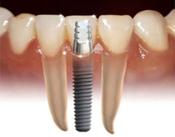 single titanium dental implant