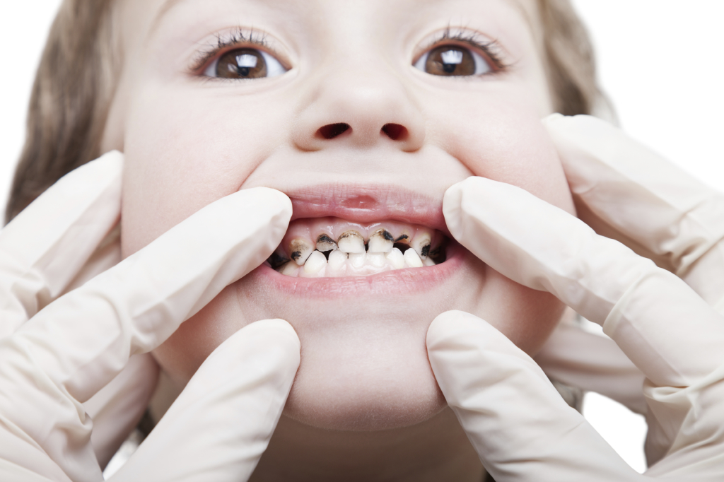 80% of Toddlers Didn’t Visit The Dentist Last Year