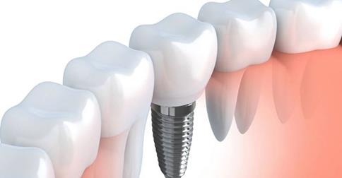 Are You Maintaining Your Dental Implants?