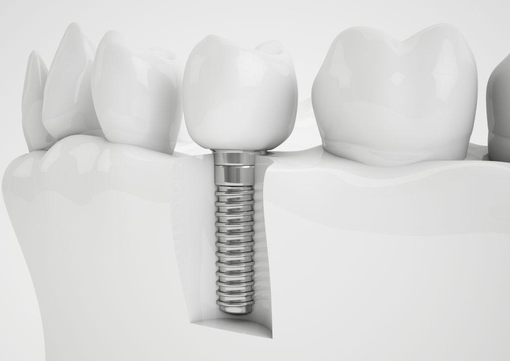Dental Implants, Crowns or Bridges?