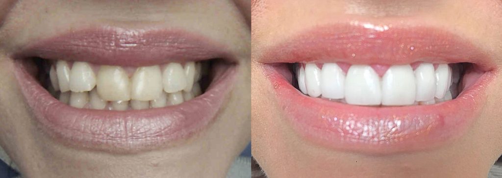 Before and after image of a smile makeover created using crowns and veneers at Gentle Dental care Liverpool