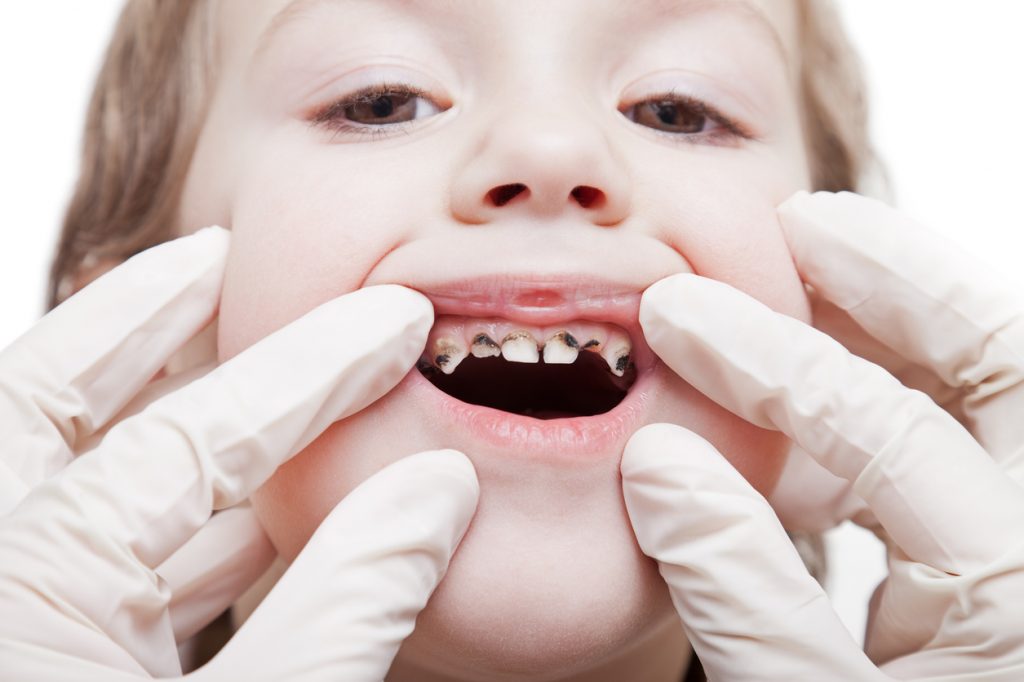 tooth decay in child