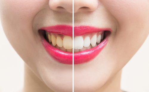 Perfect smile teeth before and after bleaching