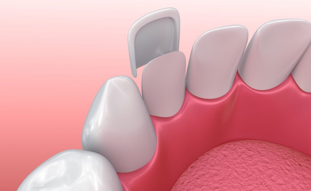 Dental veneer being placed on bottom front tooth