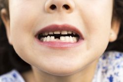 A girl showing where her baby tooth has fallen out