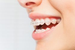 Woman's smile with clear dental braces on teeth