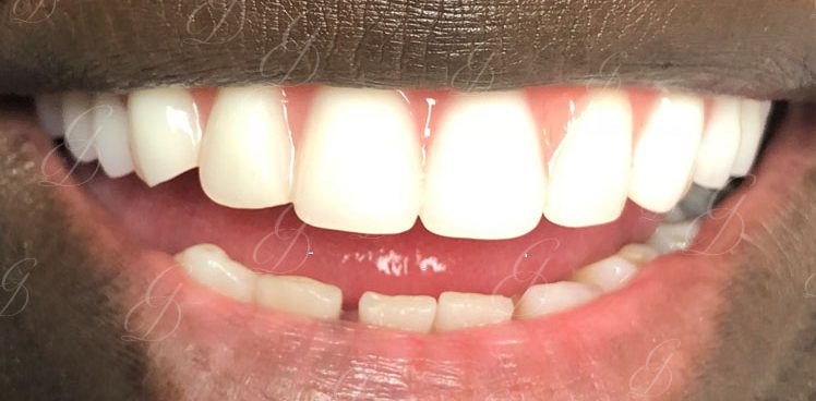 Dental Implants Liverpool | Gentle Dental Care
