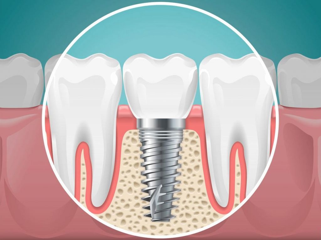 Getting Dental Implants – What to Expect