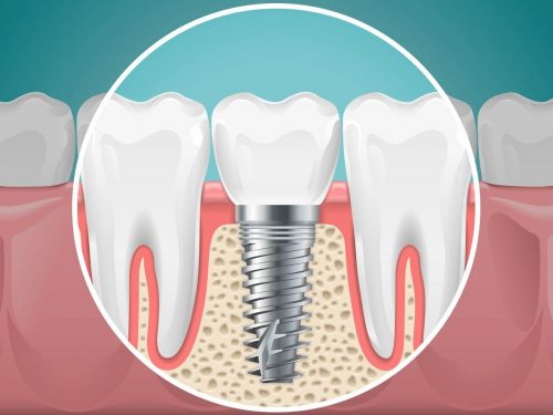 Getting Dental Implants – What to Expect