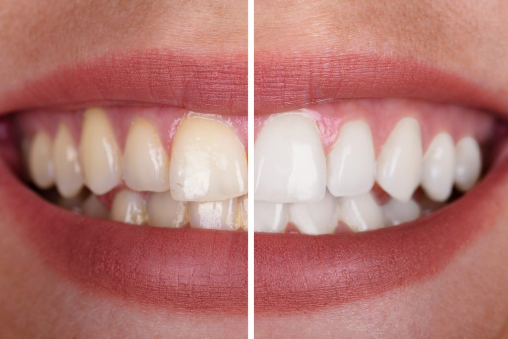 Teeth Whitening – What to Expect