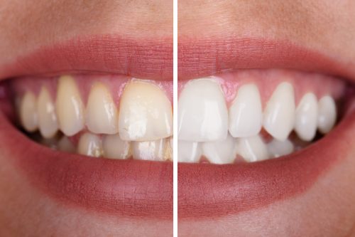 Teeth Whitening – What to Expect